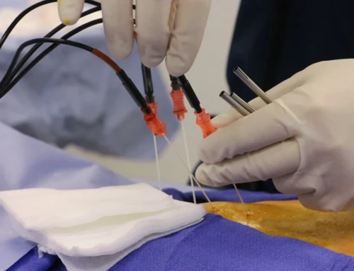 Elèctrodes contra tumors no operables: l’Hospital del Mar tracta una quinzena de casos en 5 anys